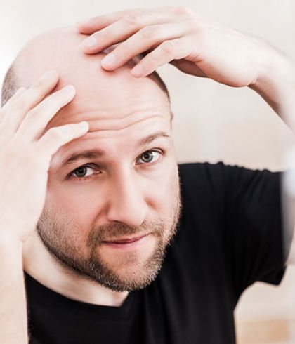 Common Signs That Indicate You Are Going Bald