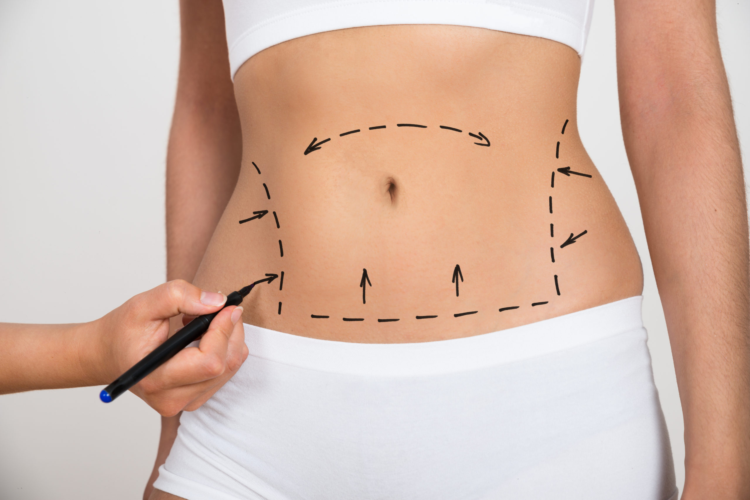 Liposuction Vs. Non-Surgical Fat Reduction: A Comprehensive Comparison