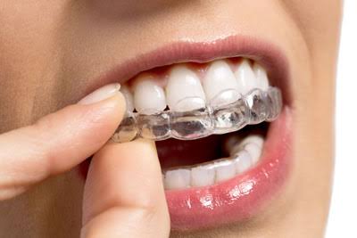 Straighten Your Teeth Discreetly: Exploring Invisalign for Orthodontic Treatment