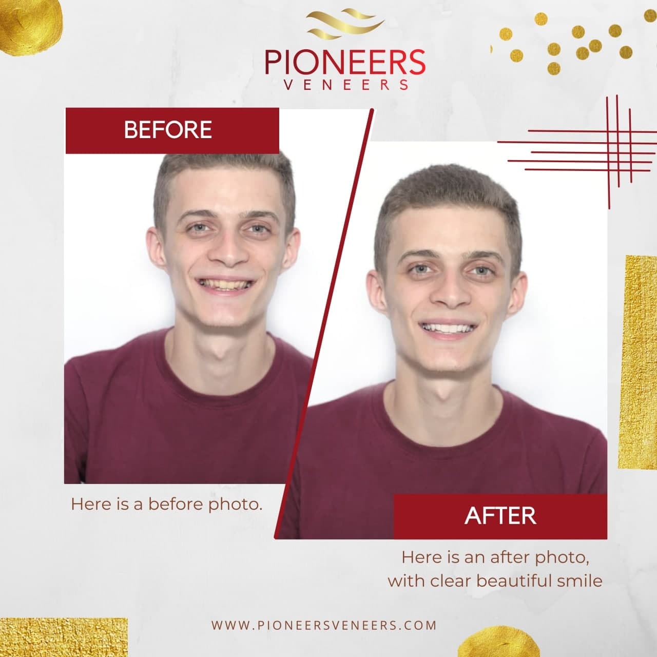 Snap-On Veneers – The Future Of Smiles