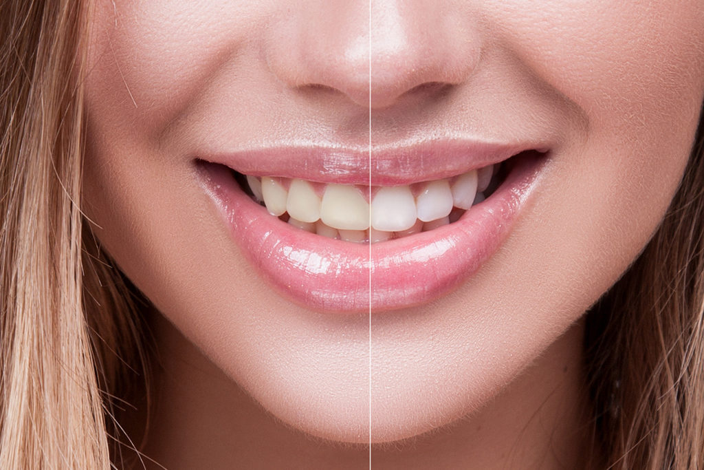Teeth Whitening in Minneapolis