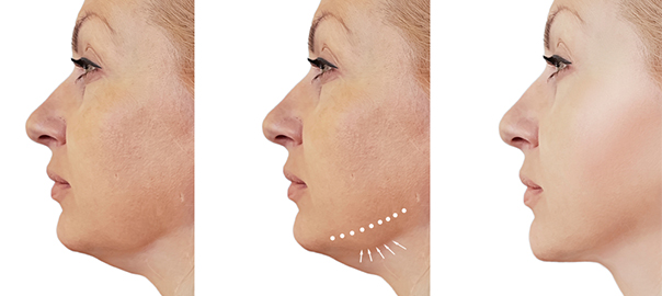 How to Get Rid of Turkey Neck: Effective Tips and Solutions