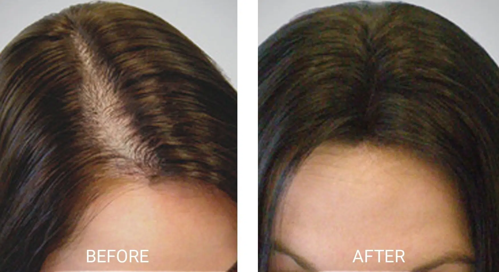 Can you exercise after PRP hair treatment?