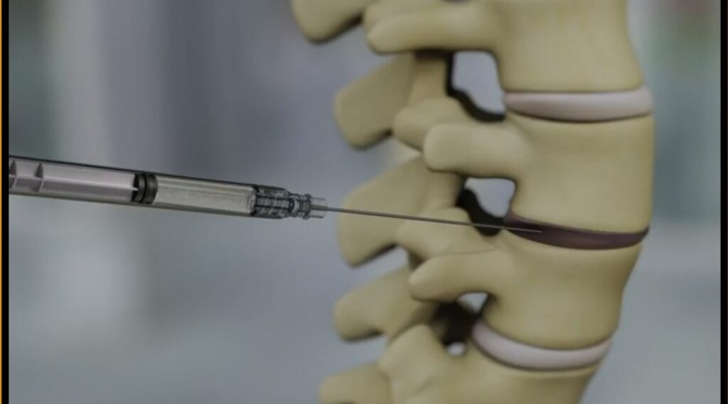 Back Pain and the Mind-Body Connection: A Deeper Dive into Psychosomatic Origins 1