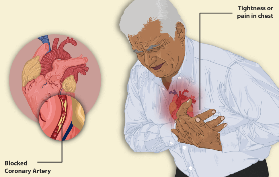Angina Pain