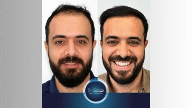 Enhancing Your Appearance with DHI Hair