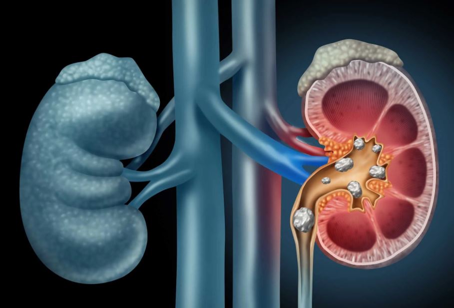 Navigating Kidney Stone Diagnosis Techniques and Technologies