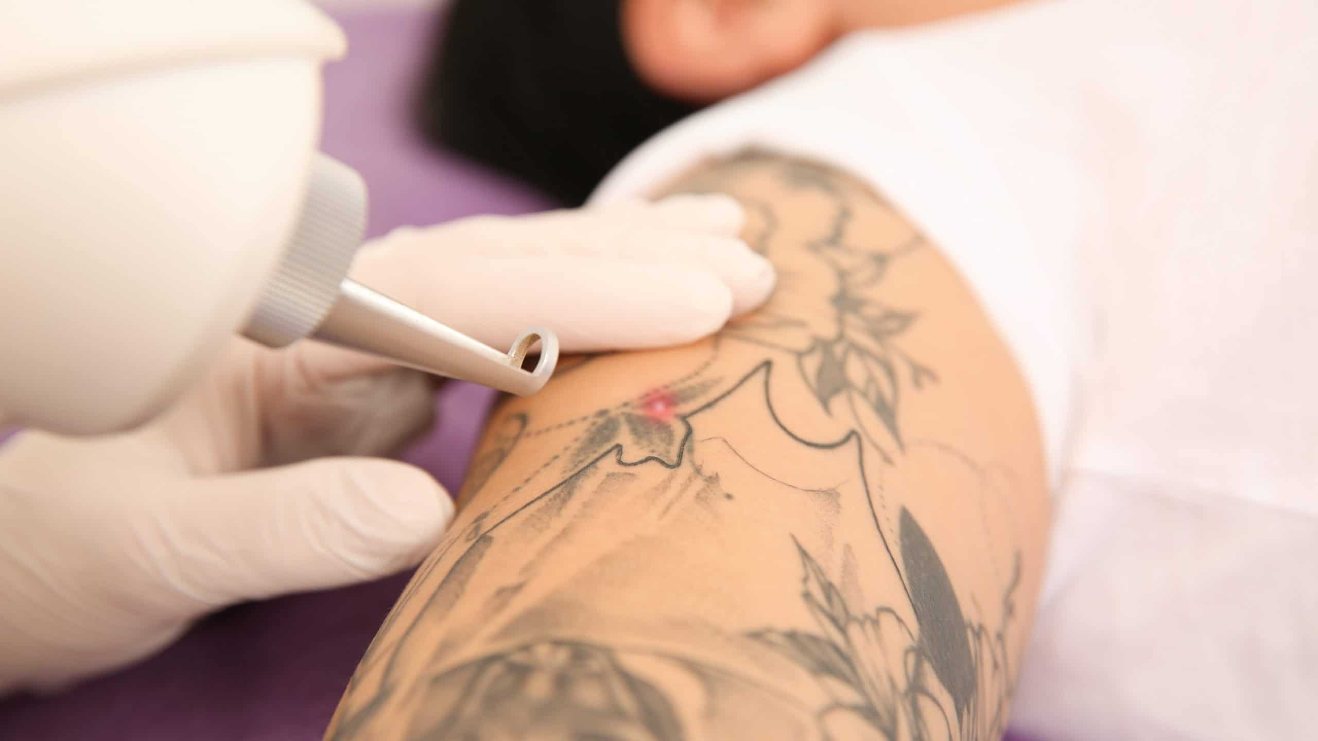 Exploring the Techniques of Tattoo Removal: A Guide on Erasing Unwanted Ink