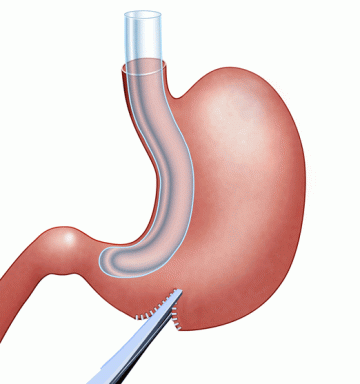 Gastric Sleeve Surgery