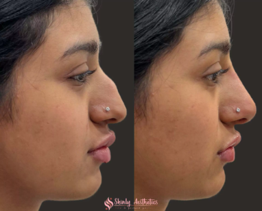 Nose Dermal Fillers and Botox in Leicester: A Comprehensive Guide to Non-Surgical Enhancements