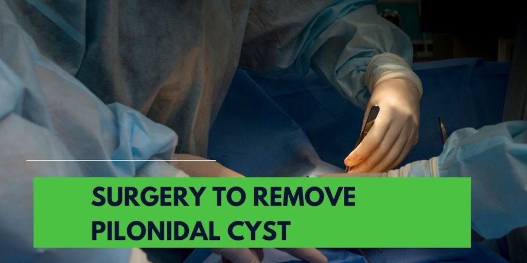 Comparing Surgical Techniques to Remove Pilonidal Cysts 1 Comparing Surgical Techniques to Remove Pilonidal Cysts